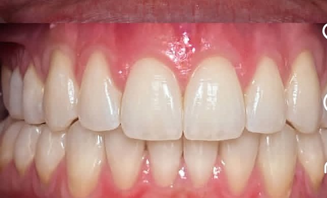 After correction of crowding and an irregular bite at Ezza Dental Care
