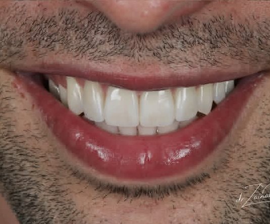After a full upper smile makeover at Ezza Dental Care