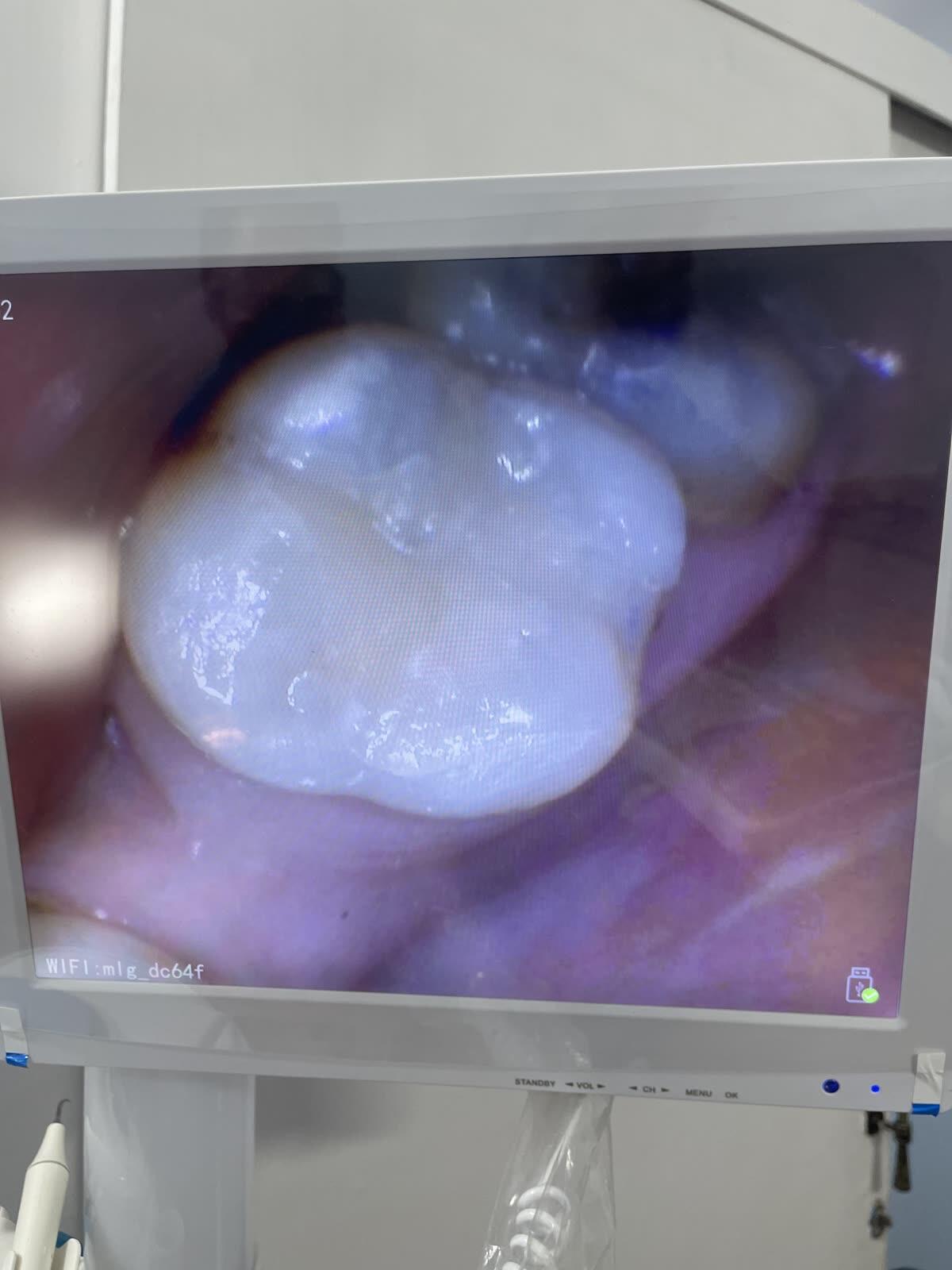 After a tooth-coloured filling on a decayed molar at Ezza Dental Care