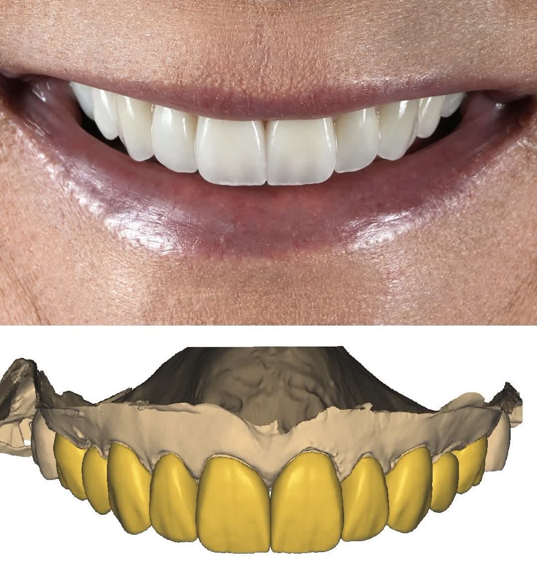 Front smile photograph paired with a digital upper-arch model for treatment planning at Ezza Dental Care