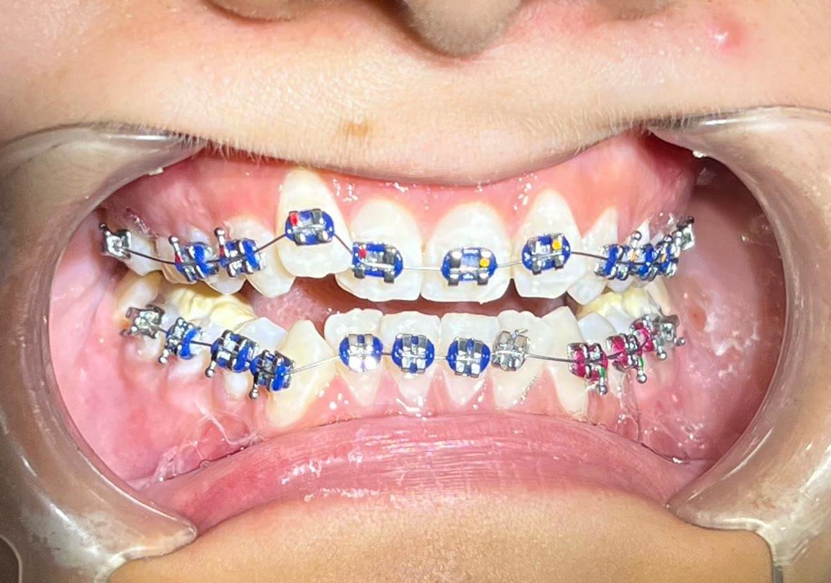 Front view of fixed metal braces with blue elastic modules on both arches at Ezza Dental Care